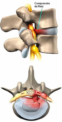 Hérnia de Disco Lombar