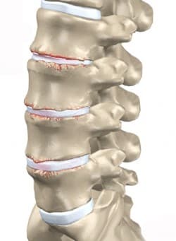 Degeneração da Coluna