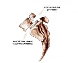 Espondilolistese e Espondilólise