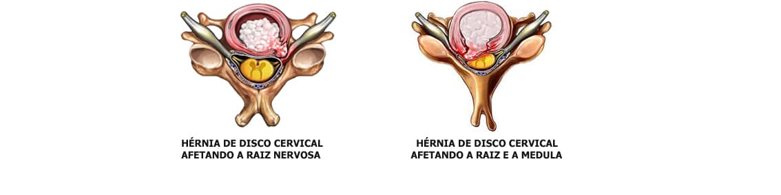 Hérnia de Disco Cervical 2 - Dr. Ernani Abreu - Ernani Abreu - Centro Cirurgia da Coluna - Cirurgia da Coluna - Porto Alegre - Centro Clínico Mãe de Deus.jpg