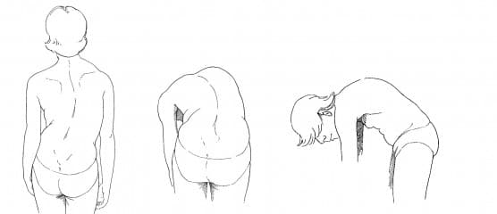 escoliose 1 - Dr Ernani Abreu.jpg