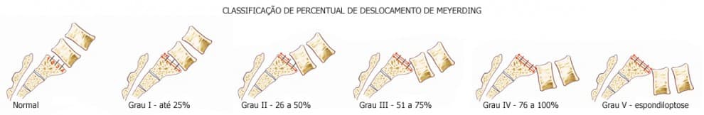 Espondilolistese e Espondilólise 1 - Dr Ernani Abreu.jpg