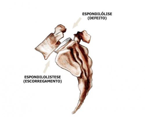 Espondilolistese e Espondilólise 2 - Dr Ernani Abreu.jpg