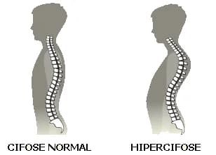 cifose 1 - Dr Ernani Abreu.jpg