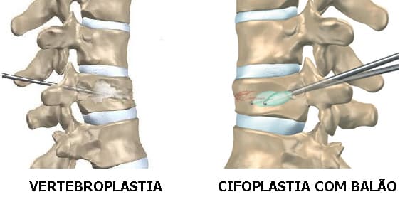 Osteoporose 1 - Dr Ernani Abreu.jpg