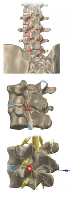 Denervação Facetária com Radiofrequência