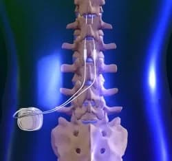 Neuroestimuladores e Bombas de Medicação