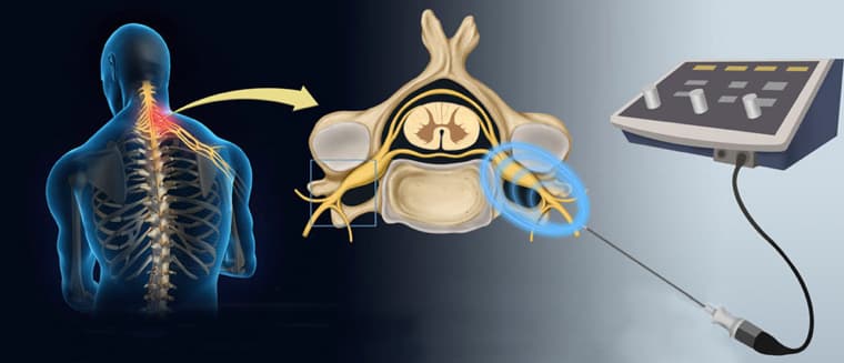 Dúvidas mais comuns sobre radiofrequência.jpg