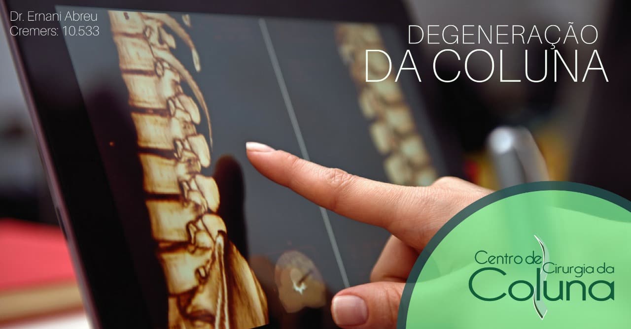 Degeneração da Coluna - Dr. Ernani Abreu - Ernani Abreu - Centro Cirurgia da Coluna - Cirurgia da Coluna - Porto Alegre - Centro Clínico Mãe de Deus.jpg